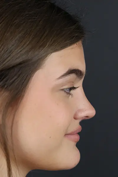 Rhinoplasty case #8366