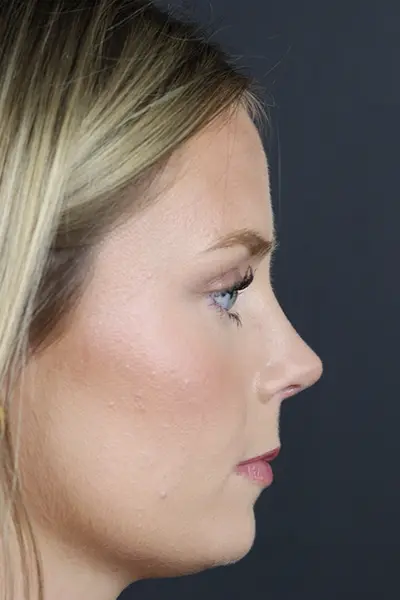 Rhinoplasty case #8344