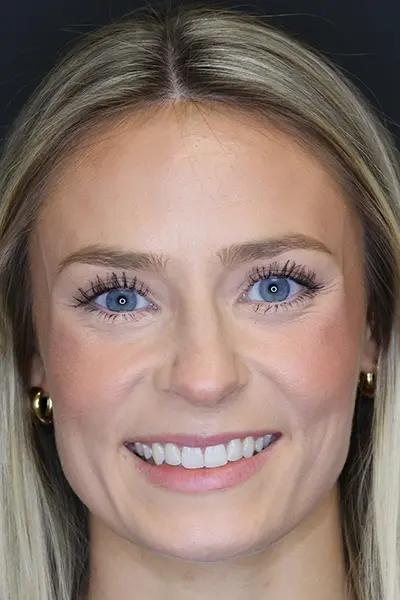 Rhinoplasty case #8344