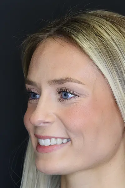 Rhinoplasty case #8344