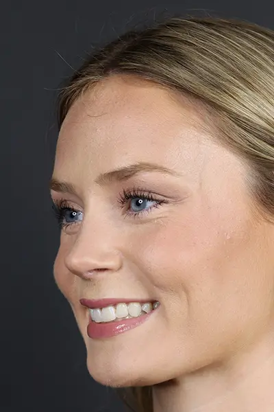 Rhinoplasty case #8344