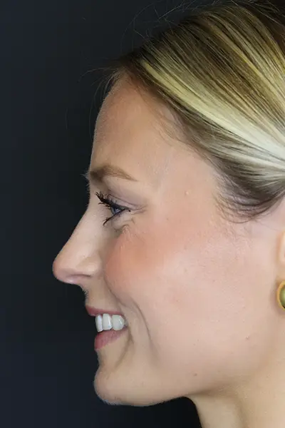 Rhinoplasty case #8344