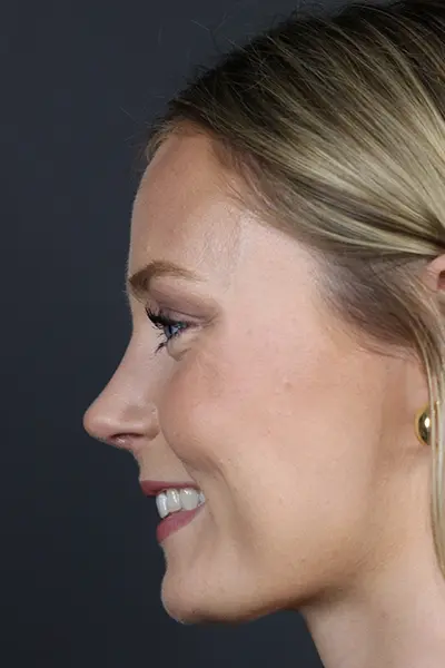 Rhinoplasty case #8344
