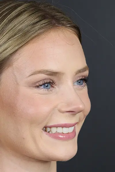 Rhinoplasty case #8344