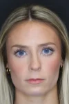Rhinoplasty case #8344