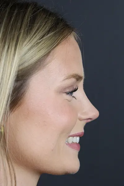 Rhinoplasty case #8344