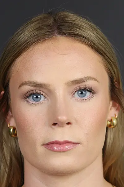 Rhinoplasty case #8344