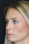 Rhinoplasty case #8344