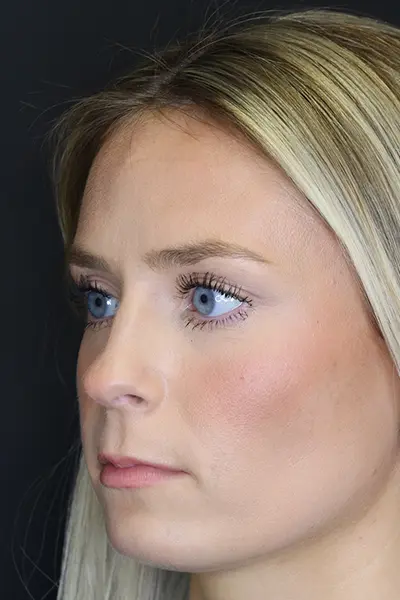 Rhinoplasty case #8344