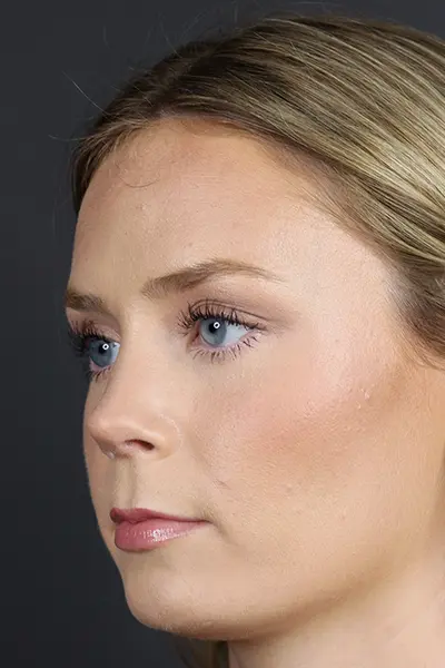 Rhinoplasty case #8344