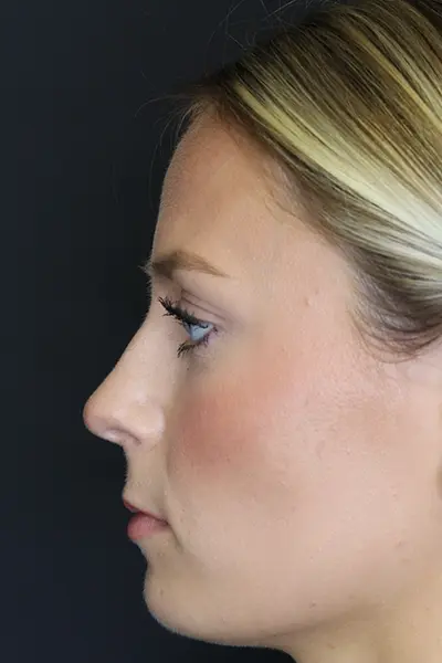 Rhinoplasty case #8344