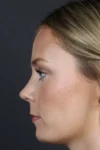 Rhinoplasty case #8344