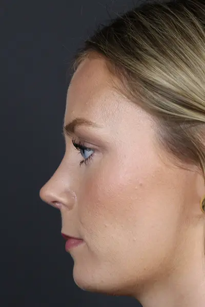 Rhinoplasty case #8344