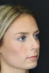 Rhinoplasty case #8344