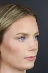 Rhinoplasty case #8344