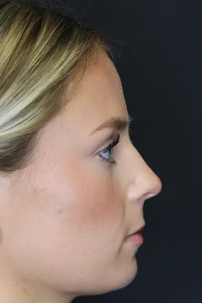 Rhinoplasty case #8344
