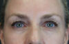 Blepharoplasty case #8950