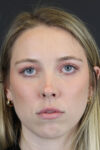 Facial Filler case #8813