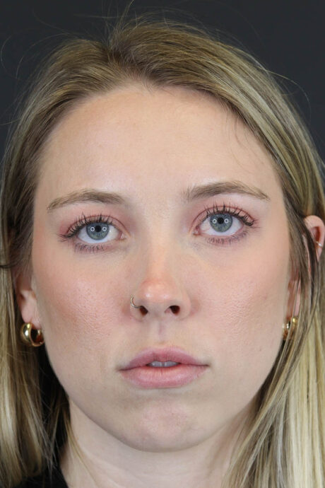 Facial Filler case #8813