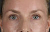 Blepharoplasty case #8950