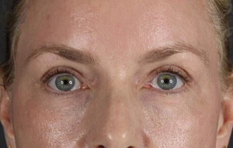 Blepharoplasty case #8950