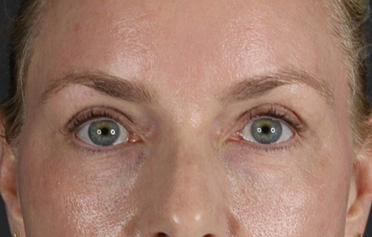Blepharoplasty case #8950