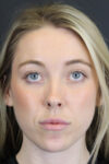 Facial Filler case #8813