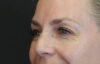 Blepharoplasty case #8950