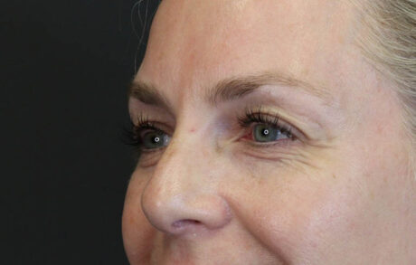 Blepharoplasty case #8950
