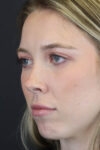 Facial Filler case #8813