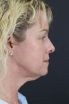 Facelift case #8959