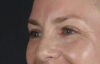 Blepharoplasty case #8950