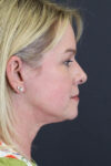 Facelift case #8959