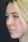 Facial Filler case #8813