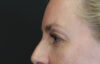 Blepharoplasty case #8950
