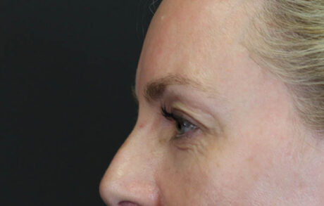 Blepharoplasty case #8950