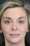Facial Filler case #8818