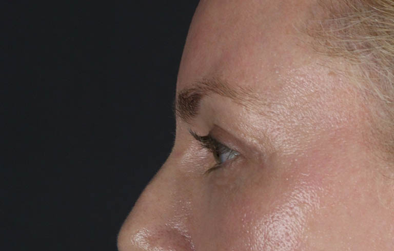 Blepharoplasty case #8950