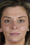 Facial Filler case #8818