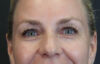Blepharoplasty case #8950