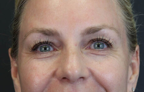 Blepharoplasty case #8950