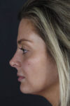 Facial Filler case #8818