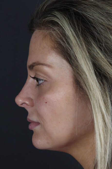 Facial Filler case #8818