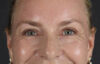 Blepharoplasty case #8950