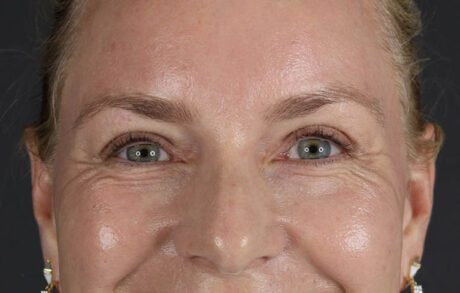 Blepharoplasty case #8950