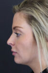 Facial Filler case #8818