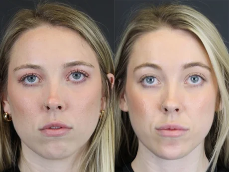 Facial Filler case #8813