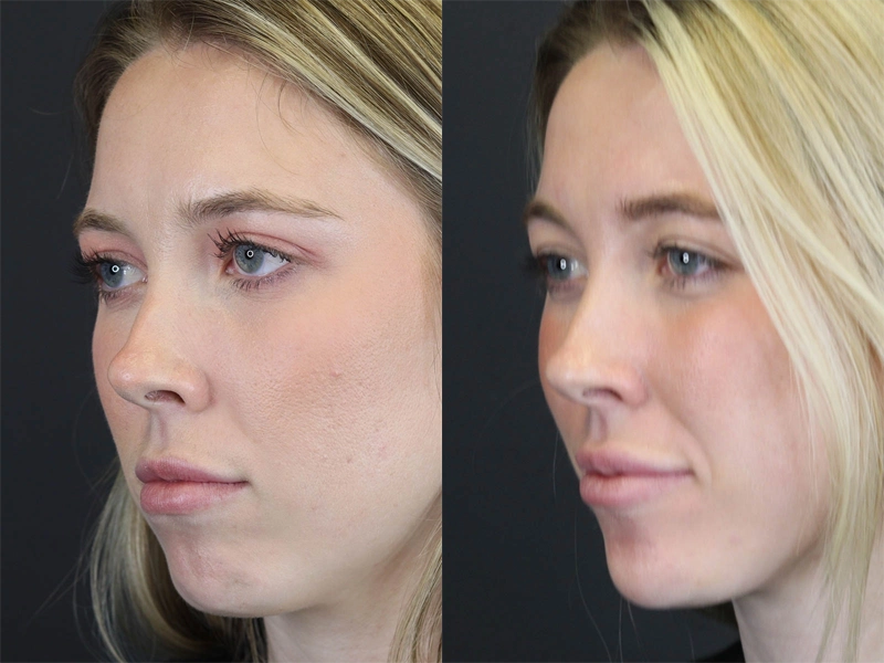 Facial Filler case #8813