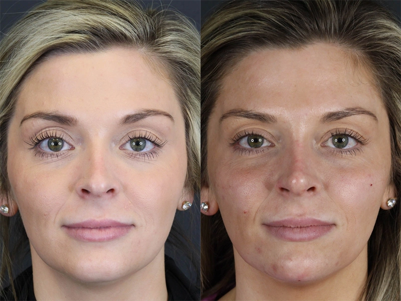 Facial Filler case #8818