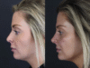 Facial Filler case #8818 slider thumbnail